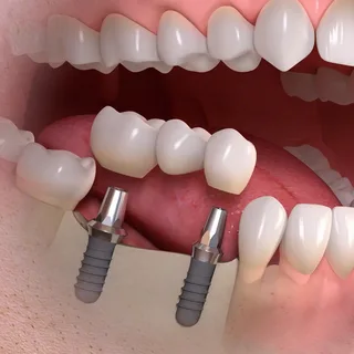 Dental Implants Alexandria
